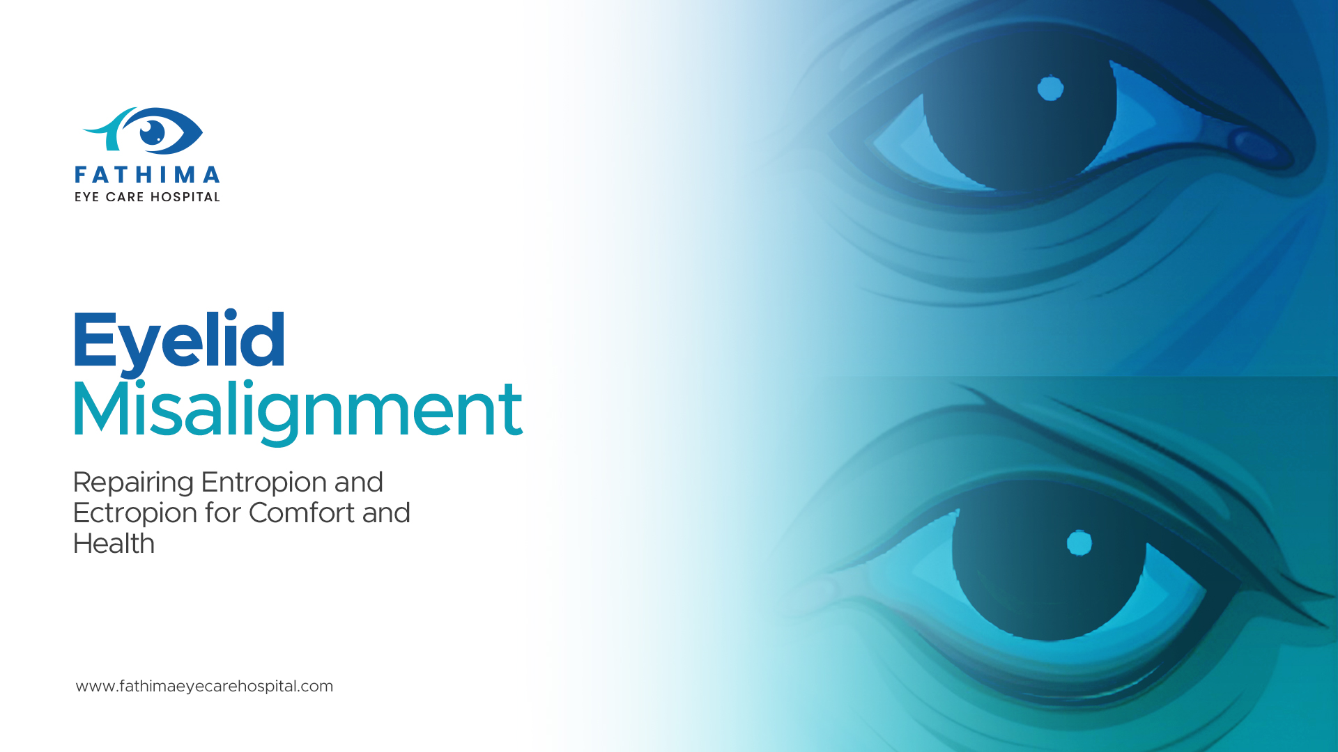 Eyelid Misalignment: Repairing Entropion and Ectropion for Comfort and Health