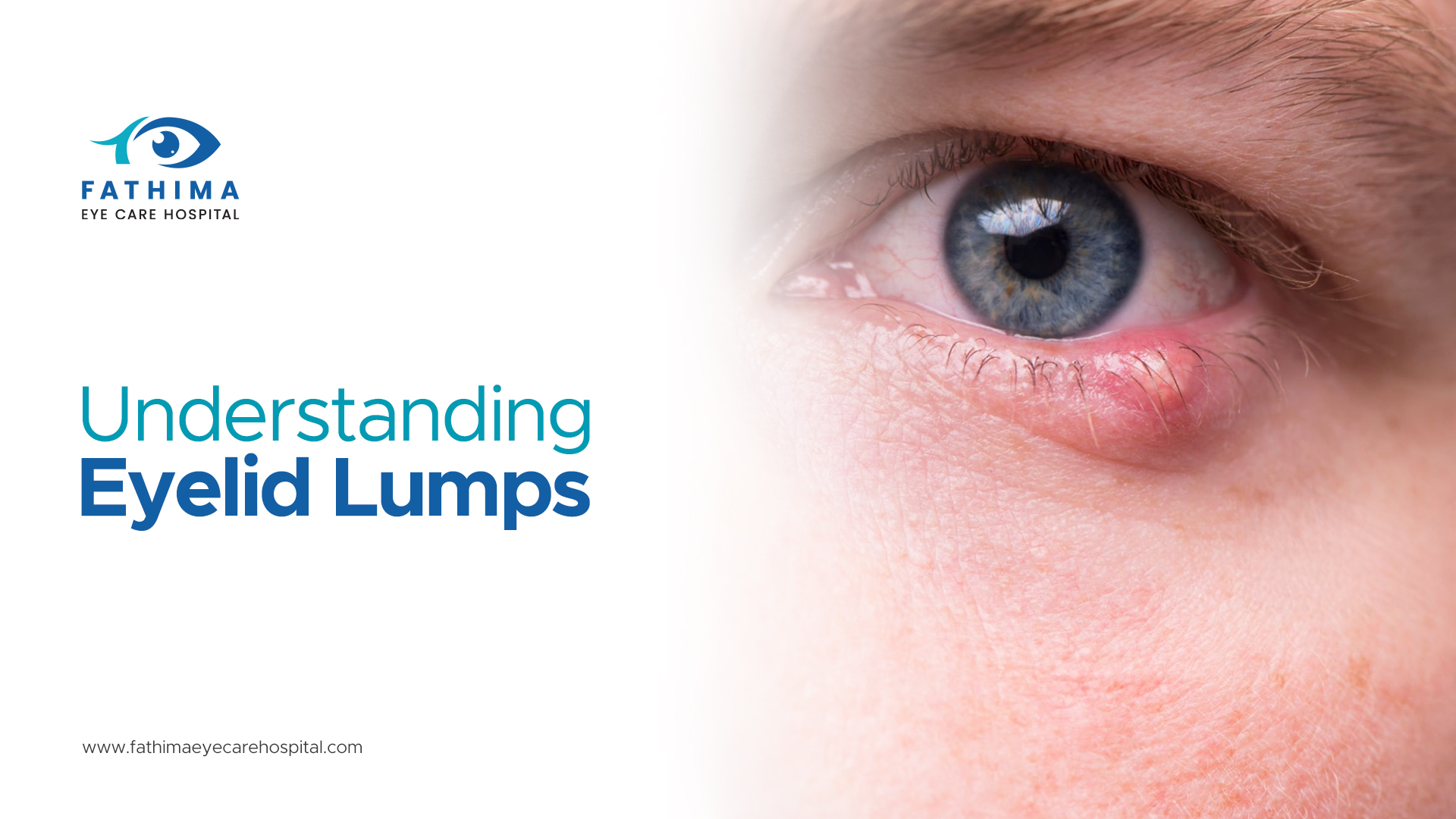 Understanding Eyelid Lumps: Treatments for Styes and Blepharitis