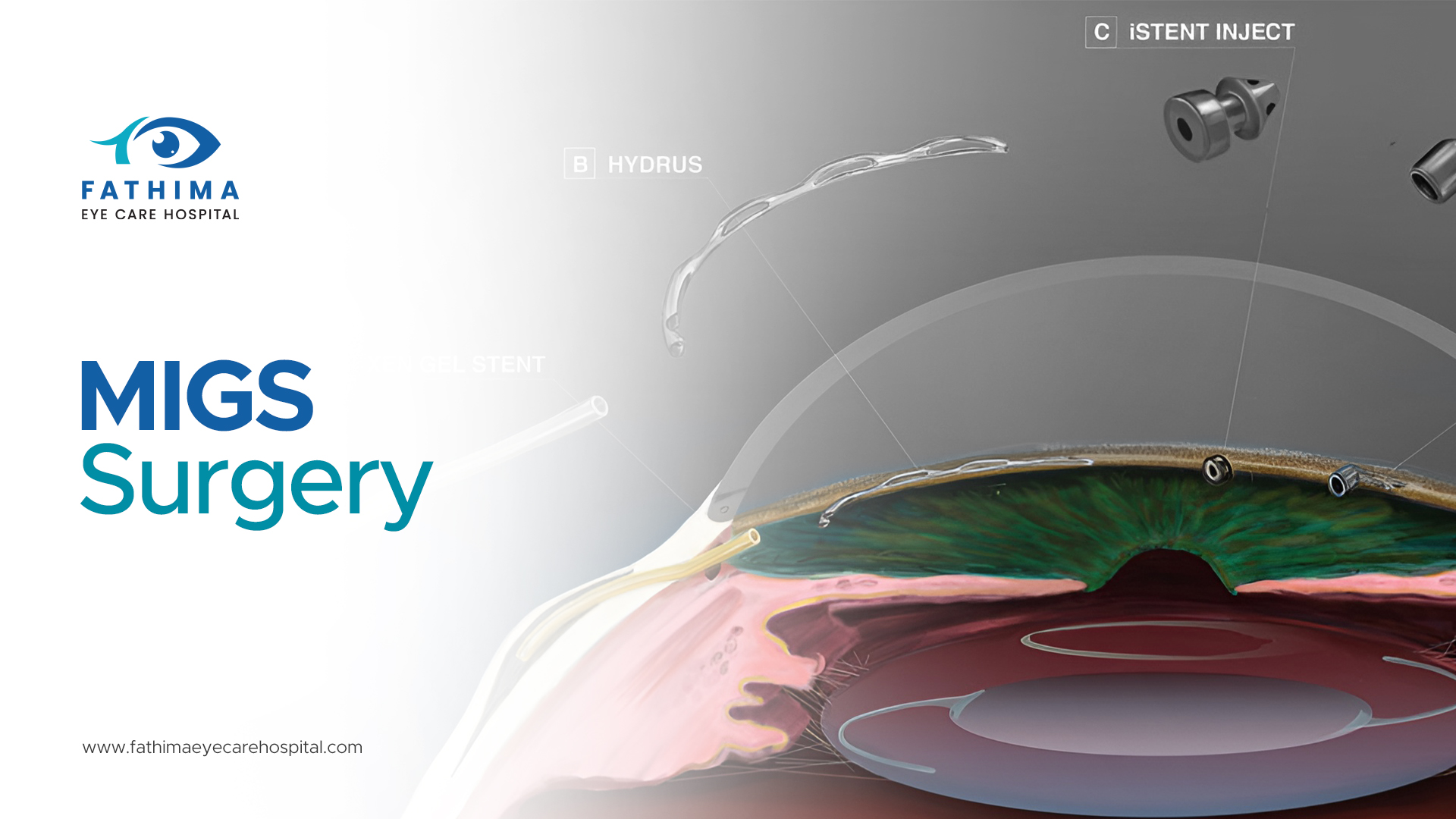 MIGS Surgery: Precision, Safety, and Faster Recovery for Glaucoma Patients