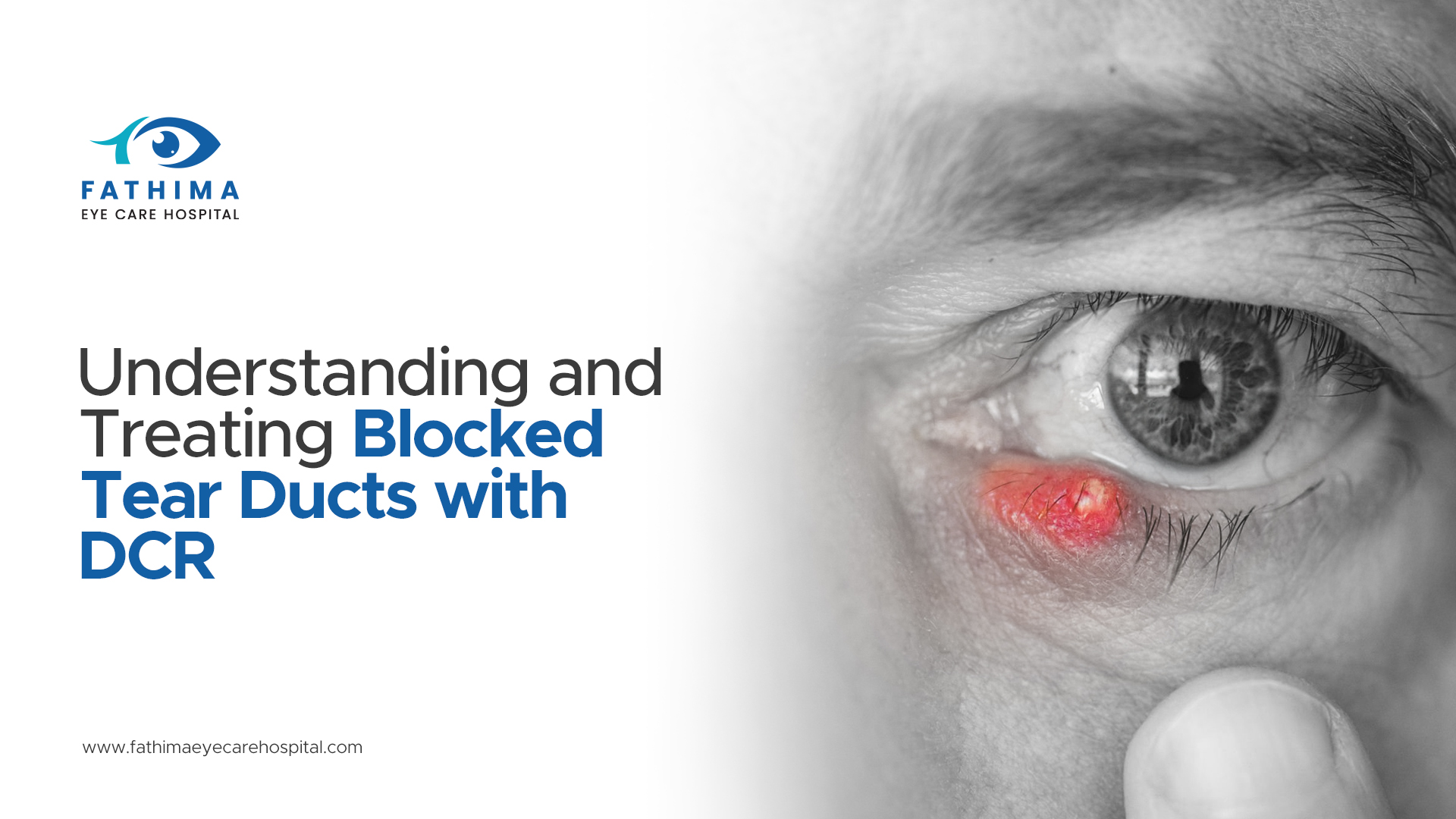Chronic Tearing? Understanding and Treating Blocked Tear Ducts with DCR