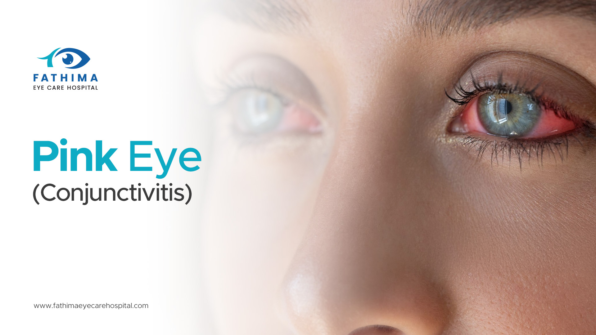 Pink Eye (Conjunctivitis): Understanding Causes, Symptoms, and Treatment