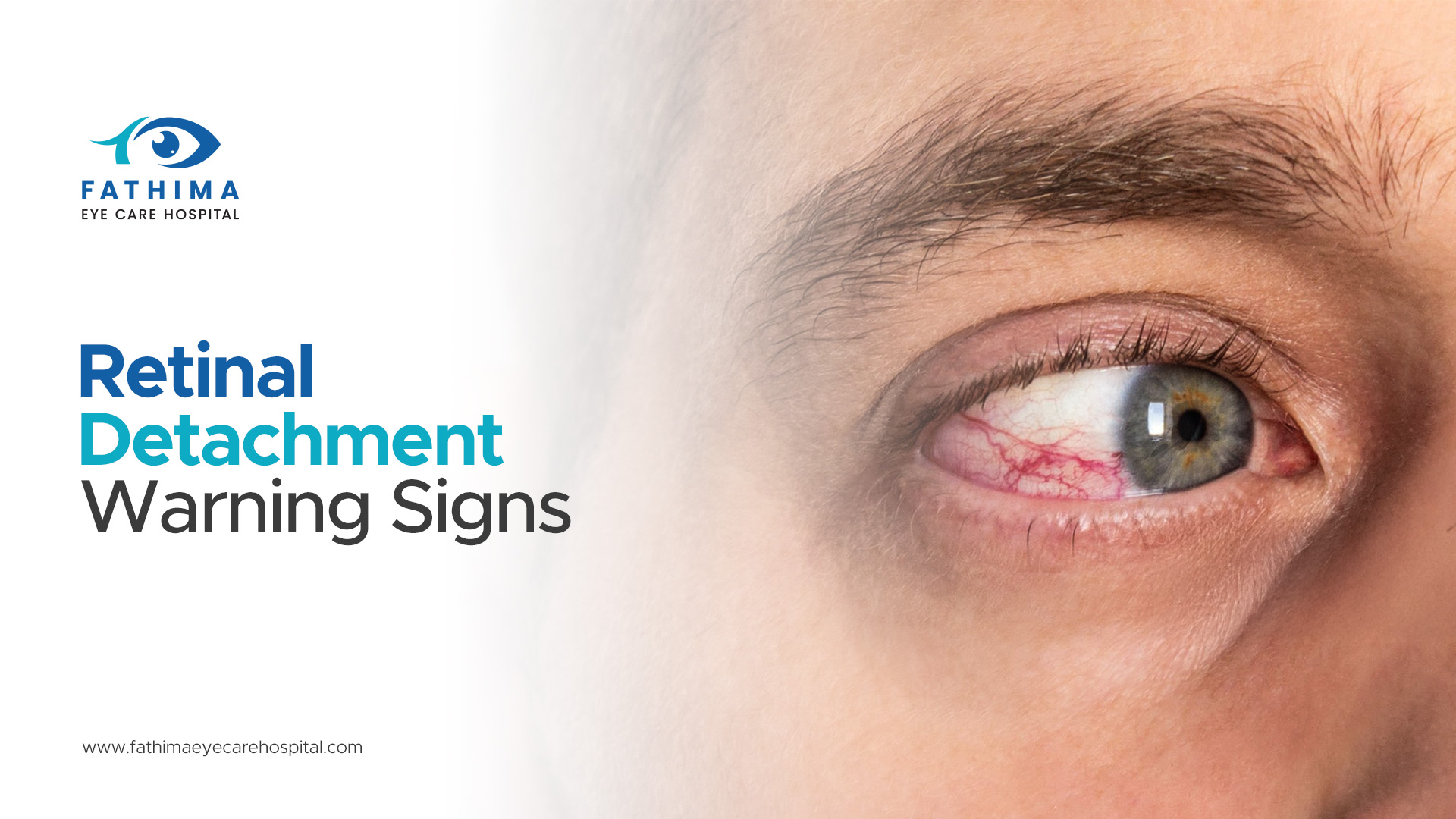 Retinal Detachment Warning Signs: Recognizing Floaters, Flashes, and Shadows